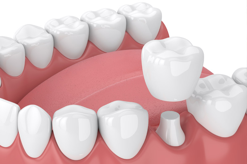 Dental Crowns in Mesa