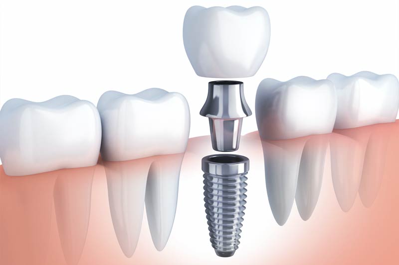Implants Dentist in Mesa