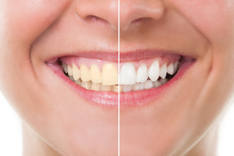 Teeth Whitening in Mesa