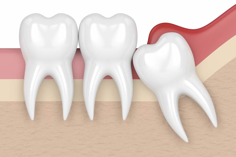 Wisdom Tooth Removal in Mesa